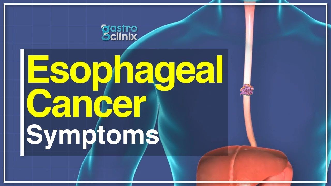 What are the symptoms of Esophageal (Food Pipe) Cancer ? Gastroclinix