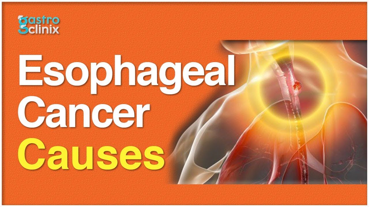 Why does Esophageal (Food pipe) cancer Occour? | Gastroclinix – alugha